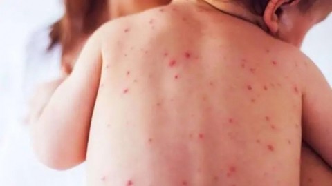 VIDEO | Río Negro avanza en acciones preventivas ante casos de varicela
