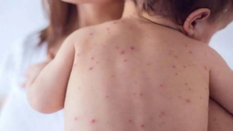 Refuerzan prevención y vacunación ante casos sospechosos de Sarampión